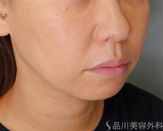 症例NO.52486のBEFORE写真