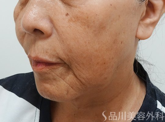 症例NO.73210のBEFORE写真