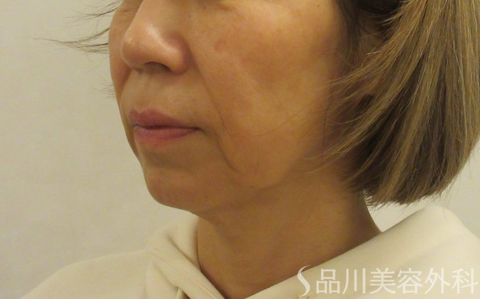 症例NO.69688のBEFORE写真