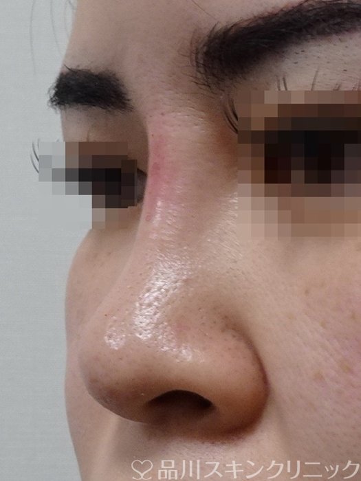 症例NO.70876のAFTER写真