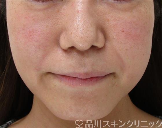 症例NO.37718のAFTER写真