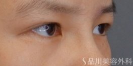 症例NO.74096のAFTER写真
