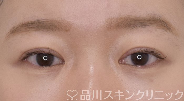 症例NO.69571のAFTER写真
