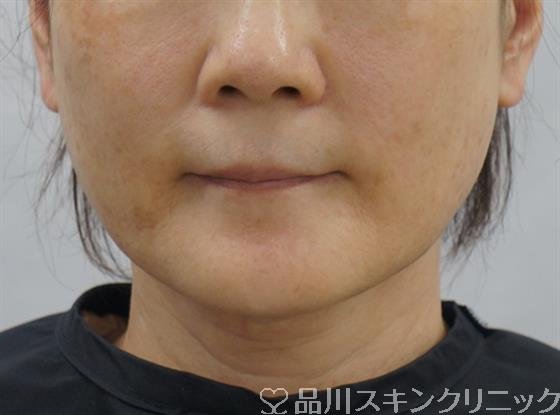 症例NO.54058のAFTER写真