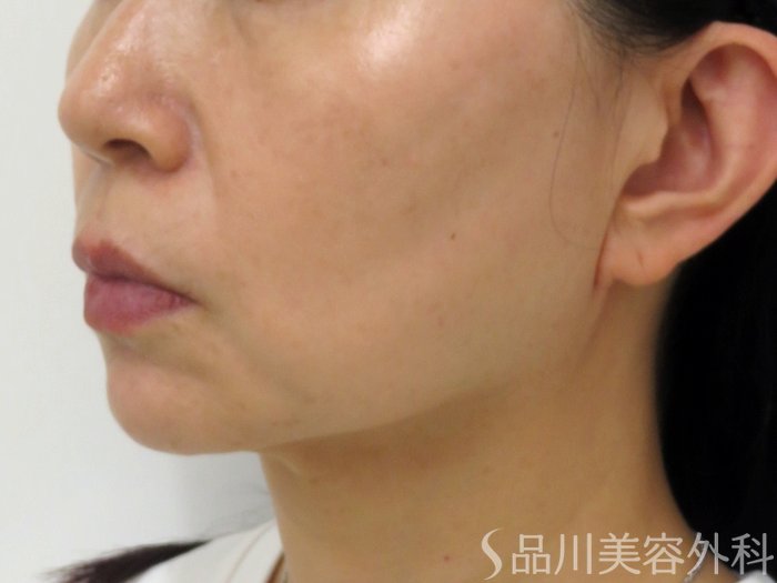 症例NO.73760のAFTER写真