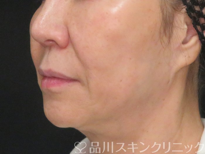 症例NO.73162のBEFORE写真