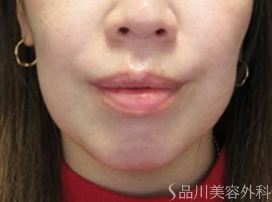 症例NO.73564のBEFORE写真