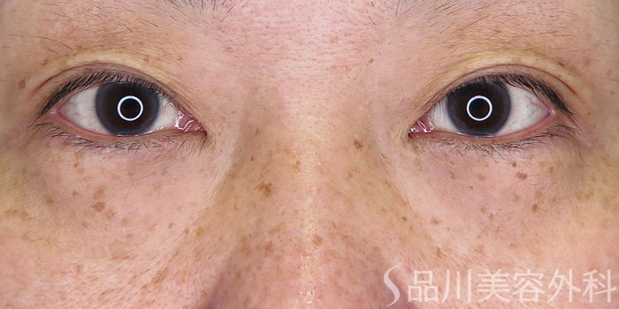 症例NO.71309のBEFORE写真