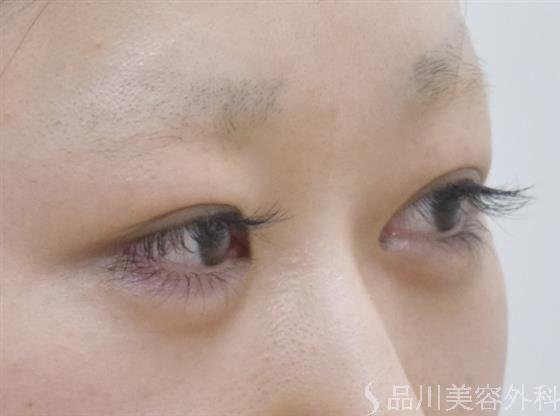 症例NO.52692のBEFORE写真