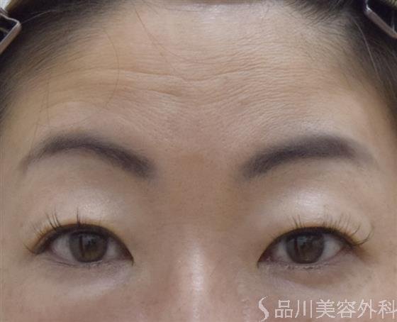 症例NO.52697のBEFORE写真