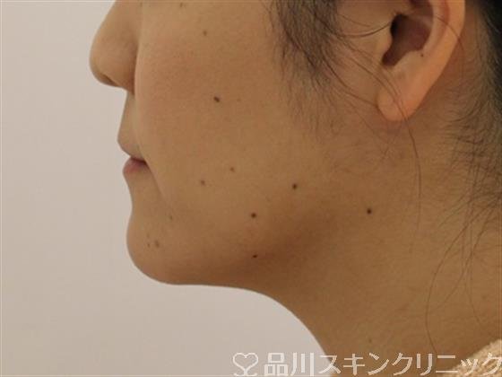 症例NO.45561のAFTER写真