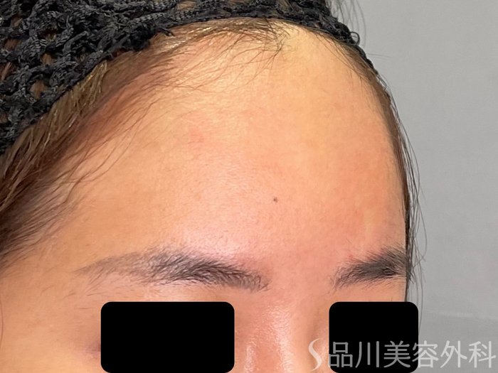 症例NO.70592のAFTER写真