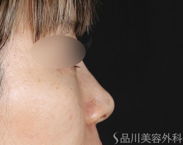 症例NO.74107のBEFORE写真