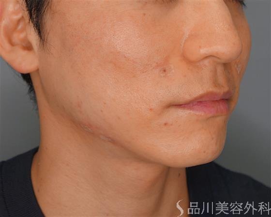 症例NO.53173のAFTER写真