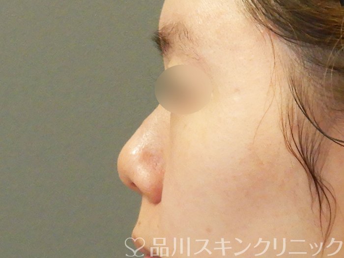 症例NO.70098のBEFORE写真