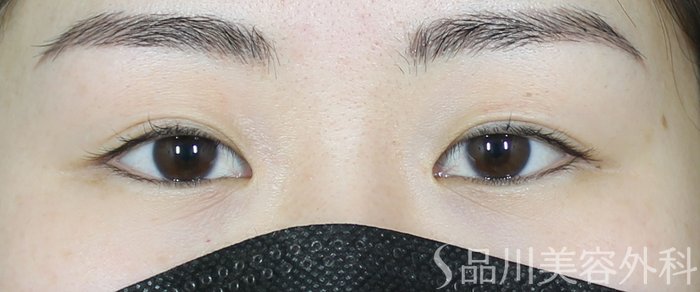 症例NO.73424のBEFORE写真