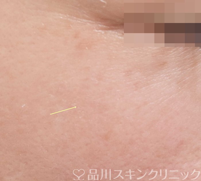 症例NO.70488のAFTER写真