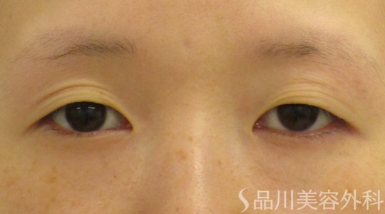 症例NO.62624のBEFORE写真