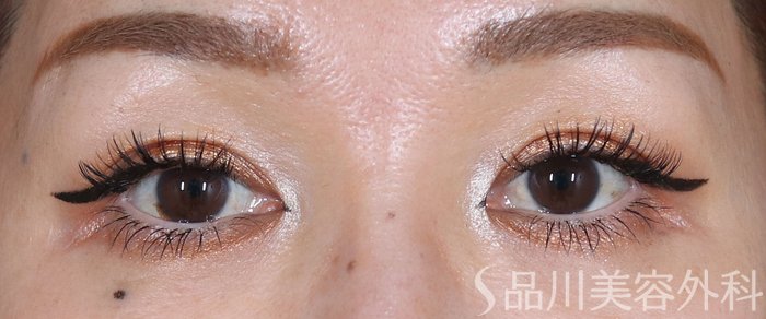 症例NO.73225のBEFORE写真