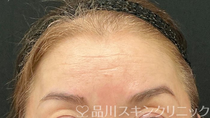 症例NO.73472のBEFORE写真