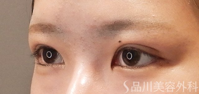 症例NO.72382のAFTER写真