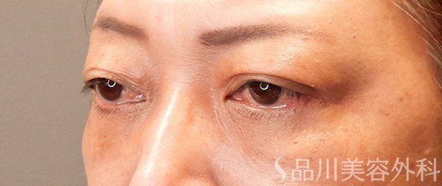症例NO.70475のAFTER写真
