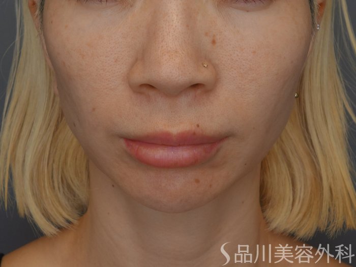 症例NO.75277のBEFORE写真