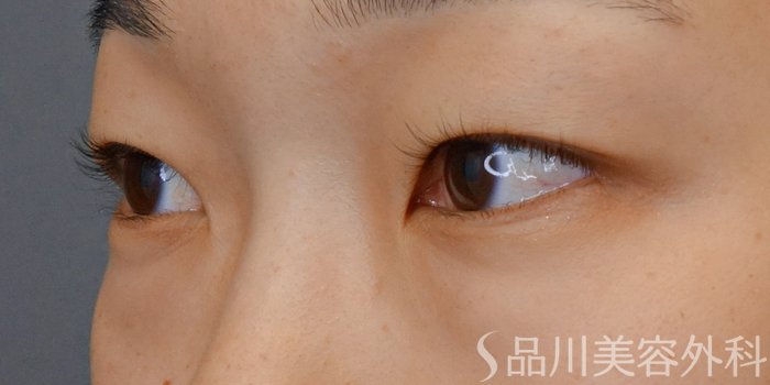 症例NO.71685のBEFORE写真