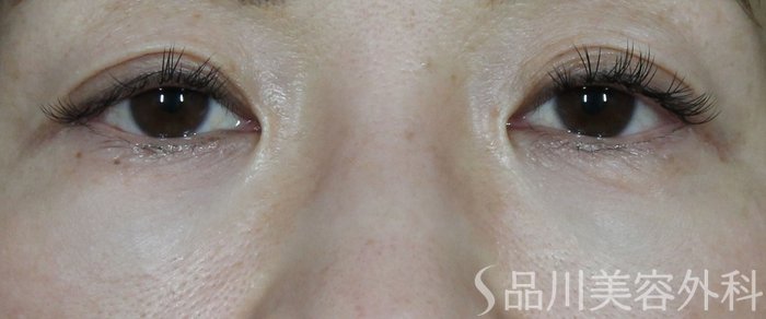 症例NO.71392のBEFORE写真