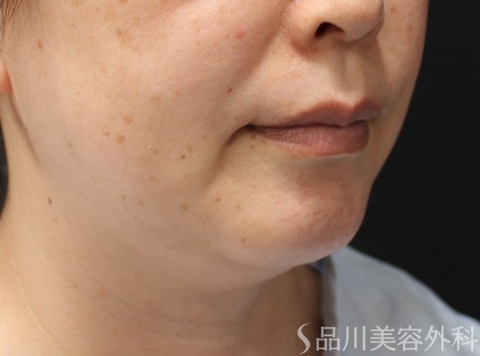 症例NO.71538のBEFORE写真