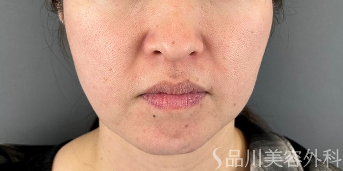 症例NO.73010のBEFORE写真