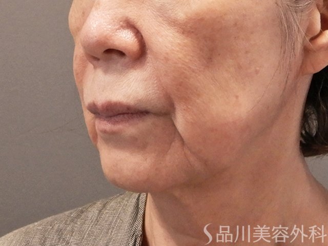 症例NO.73193のBEFORE写真