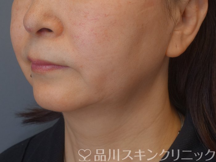 症例NO.72260のBEFORE写真