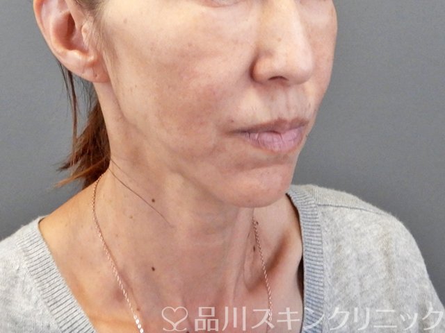 症例NO.66572のAFTER写真