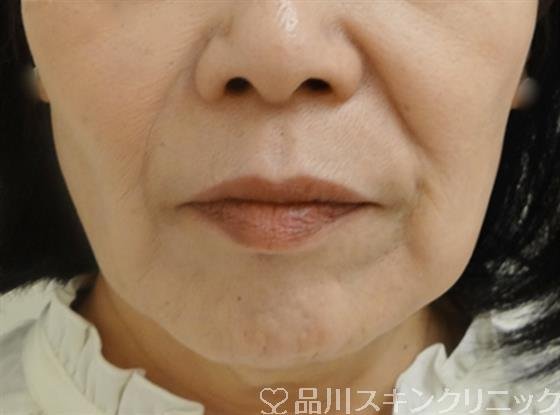 症例NO.42167のBEFORE写真