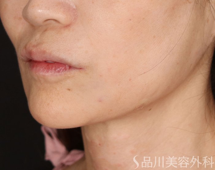 症例NO.71740のAFTER写真