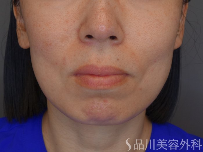 症例NO.69968のBEFORE写真