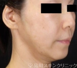 症例NO.71020のAFTER写真
