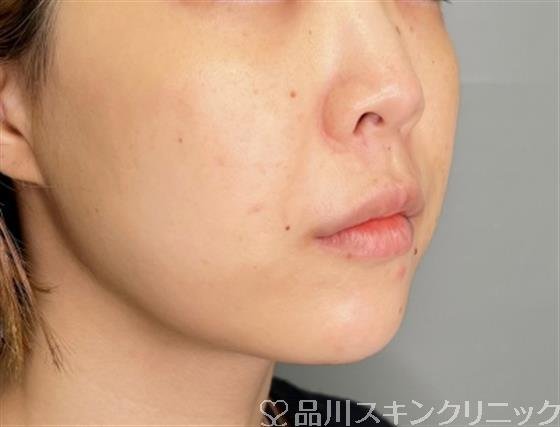 症例NO.55461のBEFORE写真