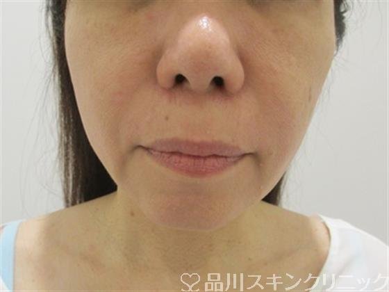 症例NO.37793のAFTER写真
