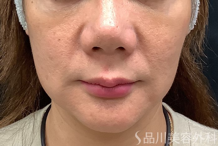 症例NO.67810のBEFORE写真