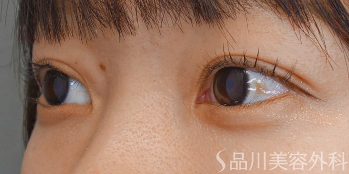 症例NO.72168のAFTER写真