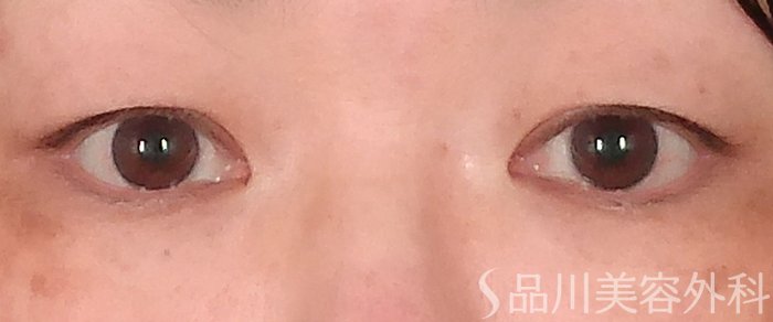 症例NO.70481のBEFORE写真