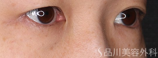 症例NO.71911のBEFORE写真