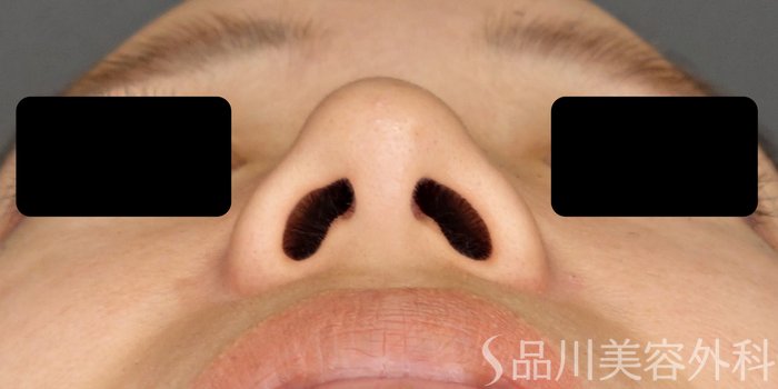 症例NO.64968のBEFORE写真