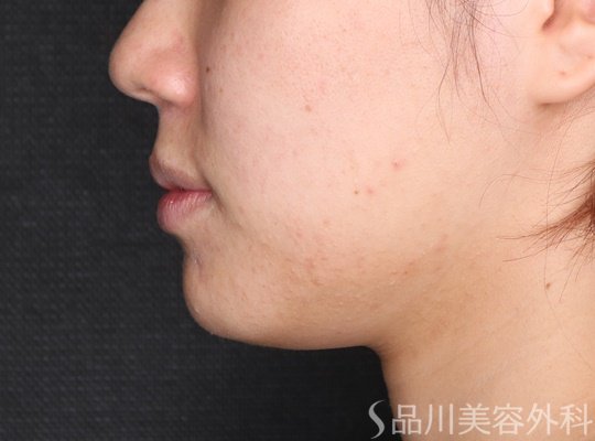 症例NO.74242のBEFORE写真