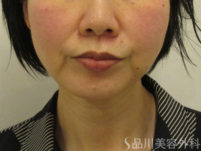 症例NO.74392のBEFORE写真