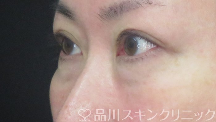 症例NO.72441のBEFORE写真