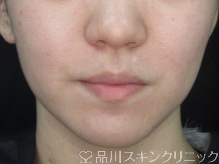 症例NO.73488のBEFORE写真