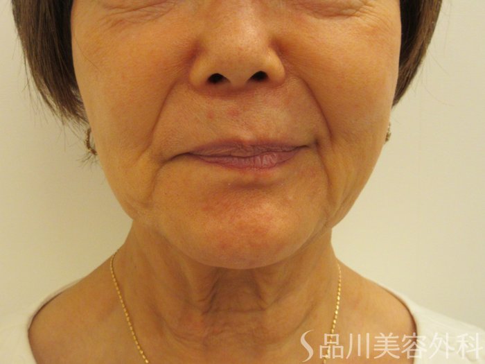 症例NO.74831のBEFORE写真